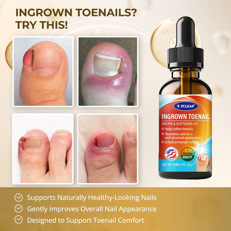 Ingrown Toenail Relief: Ingrown Toenail Drops - Ingrown Toenail Removal Kit - Toe Ingrown Nail - In Grown Toenail - Ingrown Toenail Tool - Easy Effective Solution for Ingrown Toenails - 2 Pack 1 Fl Oz (Pack of 2)