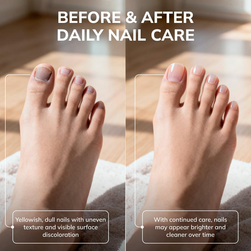 Swissklip KlearNail Toenail Stick | Medi-Care Treatment | Natural Solution for Healthy Nails I Suitable For Foot, Toe, and Fingernail I For Brittle Toenails – 10ml / 0.3 Fl. Oz. Pack 1 - Made in USA 0.3 Fl Oz (Pack of 1)