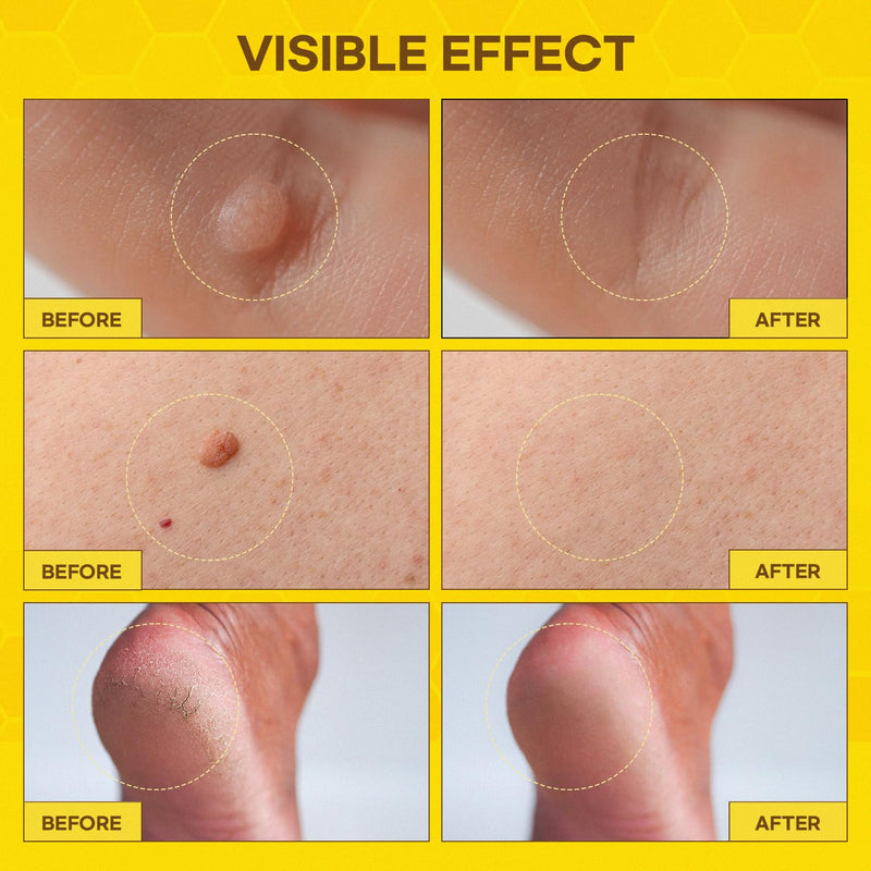 SupreH Bee Venom Wart Remover Kit: Maximum Strength Bee Venom Wart Solution with Botanical Skin Restore Cream - for Plantar and Common Wart 30 21 ML - BeesActive Australia