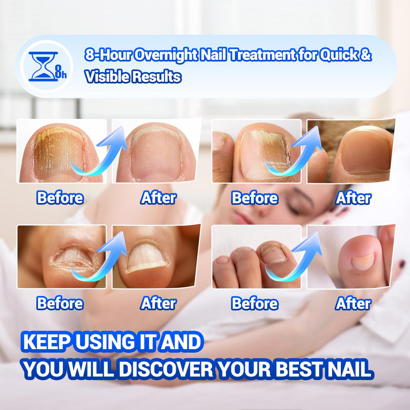 Toenail Fungus Treatment - 50Pcs Fungal Nail Patches Extra Strength with Hydrogel for Overnight Repair Nail Fungus Patches, Not Easy to Fall Off Toenail Corrector Patch 50 Count (Pack of 1)