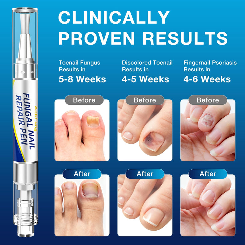 Toenail Fungus Treatment Extra Strength - AntiFung Pen with 25% Undecylenic Acid - Effective Nail Repair for Damaged Nails, Ingrown Nails & Discoloration - 3-Pack Applicator Pen - BeesActive Australia