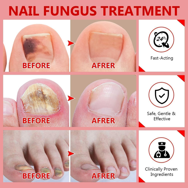 Toenail Fungus Treatment Extra Strength, Nail Fungus Treatment for Toenail, Natural Plant Extracts Toe Nail Fungus Treatments for Athletes Foot 10 Fl Oz (Pack of 1) - BeesActive Australia
