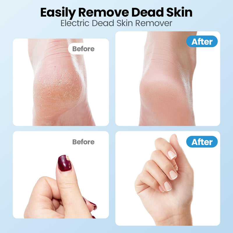 Electric Callus Remover for Feet, 2 in 1 Electric Foot File Grinder, Rechargeable Cordless Foot Scrubber for Dead Skin, Adjustable Speed with Sandpaper Discs, Professional Pedicure Tools,White Effortless Electric Foot Callus Remover White - BeesActive Australia