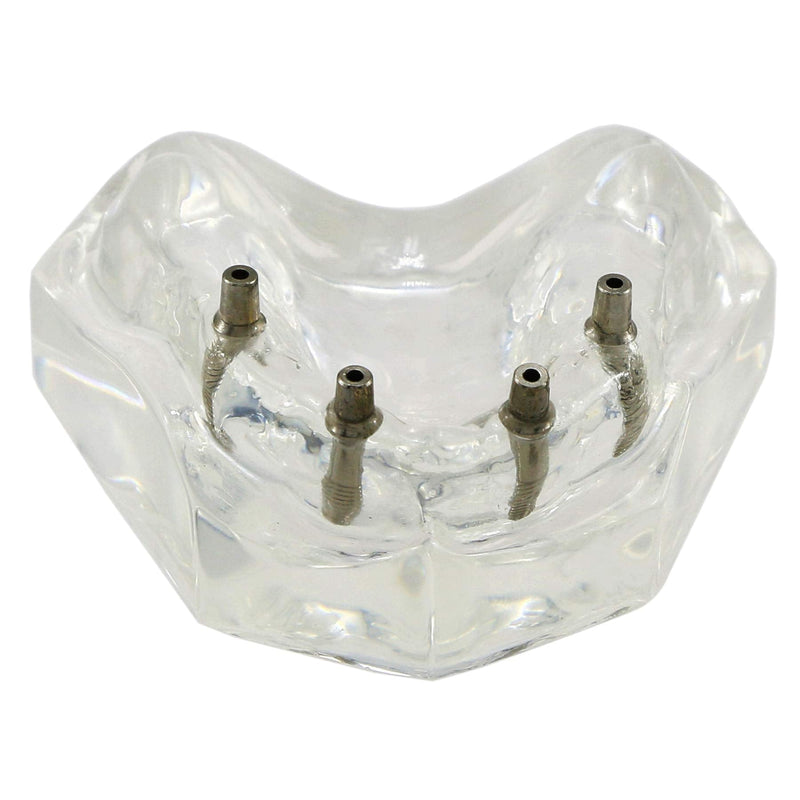 Dental Upper Implants Model Overdenture with 4 Superior Teeth Demo Transparent Vision for Education and Study Model Tool M6001 C