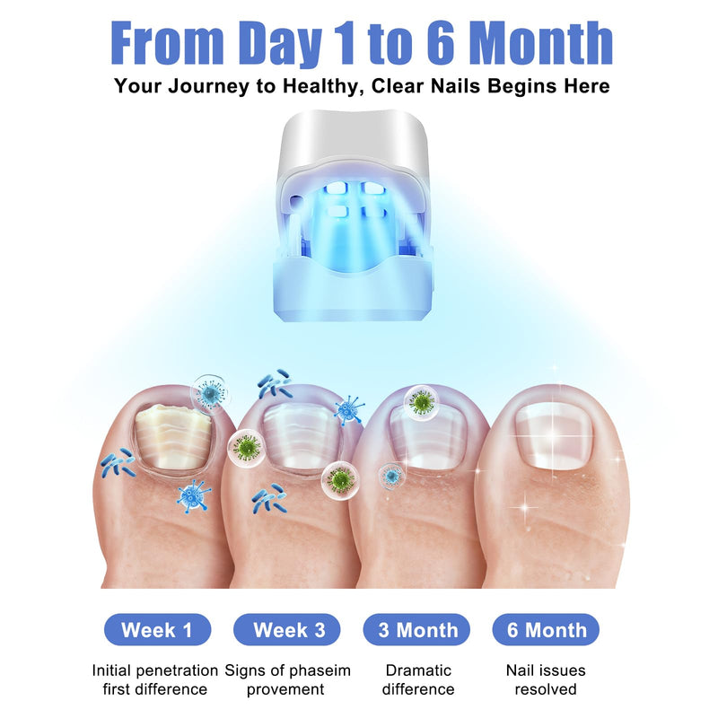 Nail Cleaning Light Device,Toenails & Fingernails Care, Home Use Nail Fungus Light Treatment Device for Multiple Nails, USB Rechargeable