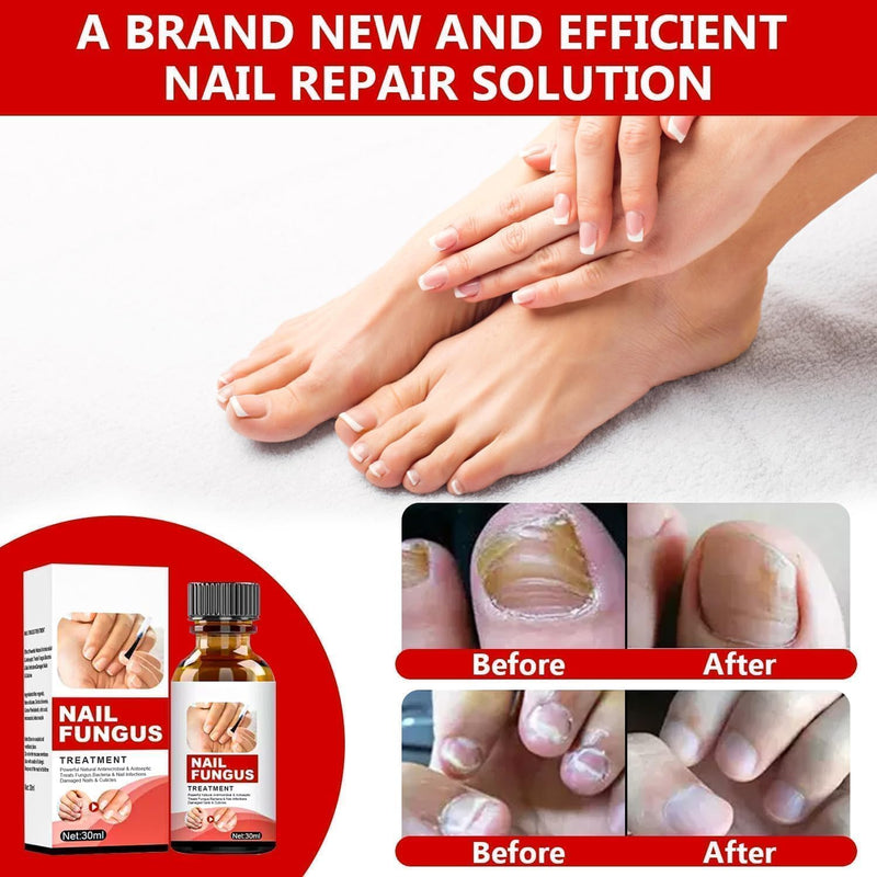 Toenail Fungus Treatment Extra Strength, Nail Fungus Treatment for Toenail, Natural Plant Extracts Toe Nail Fungus Treatments for Athletes Foot 10 Fl Oz (Pack of 1) - BeesActive Australia