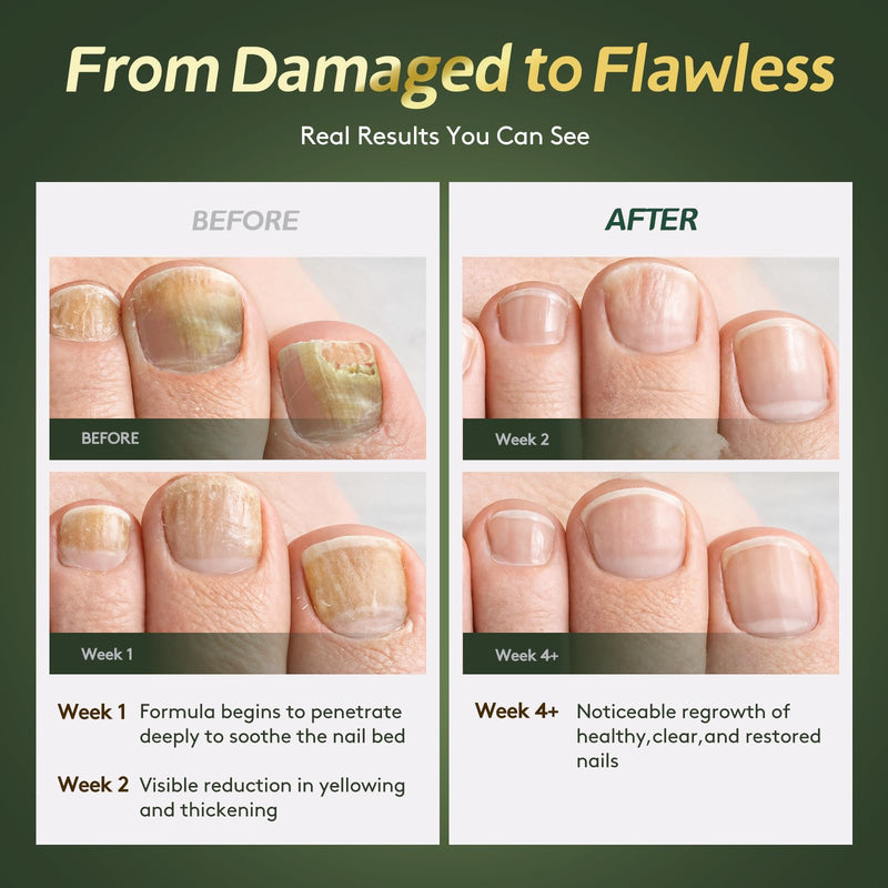 Toenail Fungus Treatment Extra Strength with Undecylenic Acid & Tea Tree Oil, Nail Fungus Treatment for Toenail & Fingernails, Antifungal Nail Repair for Damaged Nails & Thick Toenails-30ml