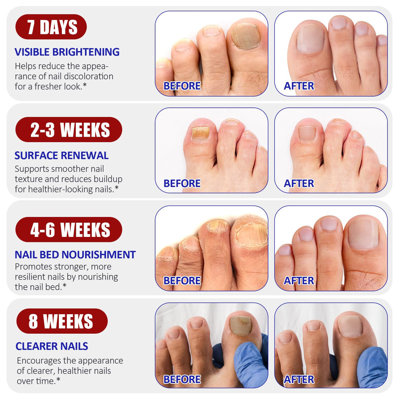 Toenail Treatment Extra Strength, 64 Pcs Nail Patches 8-Hour Overnight Nail Fast Acting Repair for Damaged, Resolve Thick, Discolored Nails, Foot Nails Repair & Care, Maintain Nail Balance 32 Count (Pack of 2)