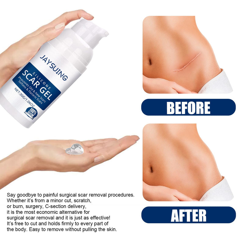 Scar Gel Scar Cream for Surgical Scars C-Section Stretch Marks Acne Injury Burns Keloids Hypertrophic For Old & New Scars