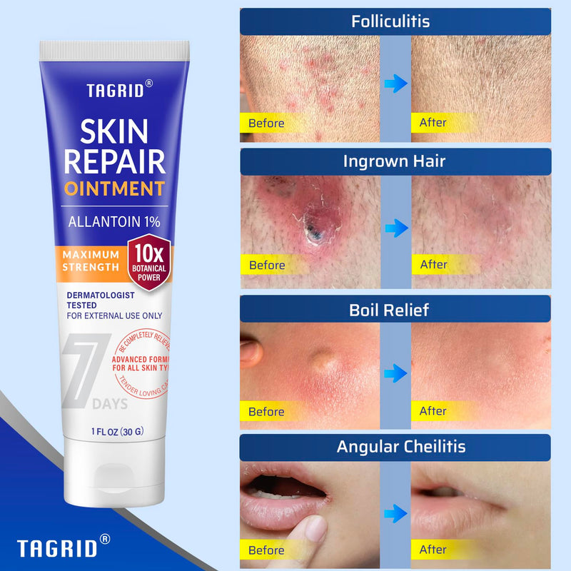 TAGRID Skin Repair Ointment (1 Oz) for Ingrown Hair, Folliculitis, Boils, Angular Cheilitis, Lichen Sclerosis, Impetigo, and Pitted Keratolysis Treatment - Maximum Strength Antifungal Cream 1 Ounce - BeesActive Australia