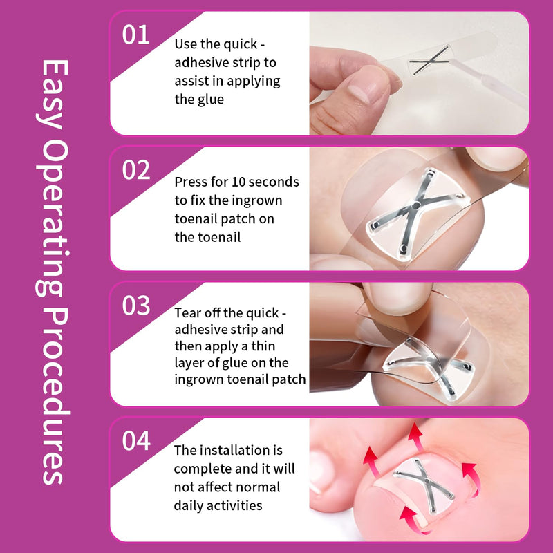 10 Patchs X-Shaped Upgrade Titanium Alloy Ingrown Toenail Corrector,At Home Ingrown Toenail Treatment for Man and Women,Ingrown Toenail Removal Kit,Curved Toenail Straightener (1 Count (Pack of 16)) 1 Count (Pack of 16)