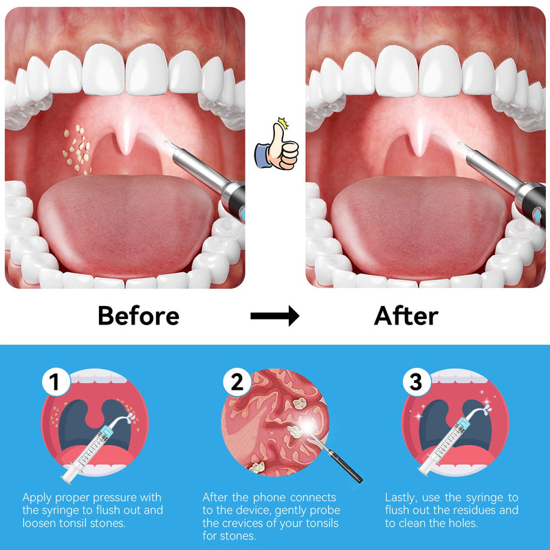 Upgraded Tonsil Stone Remover with Camera, Visual Tonsil Stone Removal Kit with 6 LED Light, Tonsil Stone Removal Tool Camera with 1080P, 5 Head Attachments, for iOS & Android (Black) Black - BeesActive Australia
