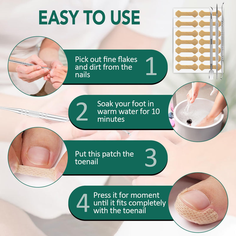 Ingrown Toenail Treatment, 100 Pcs Breathable Ingrown Toenail Strips, Toenail Corrector Patch with 3 Pedicure Tools for At-Home Pedicure and Foot Care (Style 04) Style 04 - BeesActive Australia