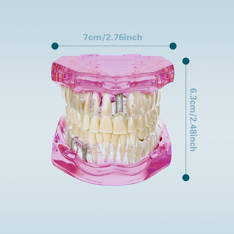 Transparent Disease Teeth Model with Dental Implant Bridge, Dental Teach Crown Bridge Removable Model, Tooth Model for Patient and Dental Student Education. (Red) Red - BeesActive Australia
