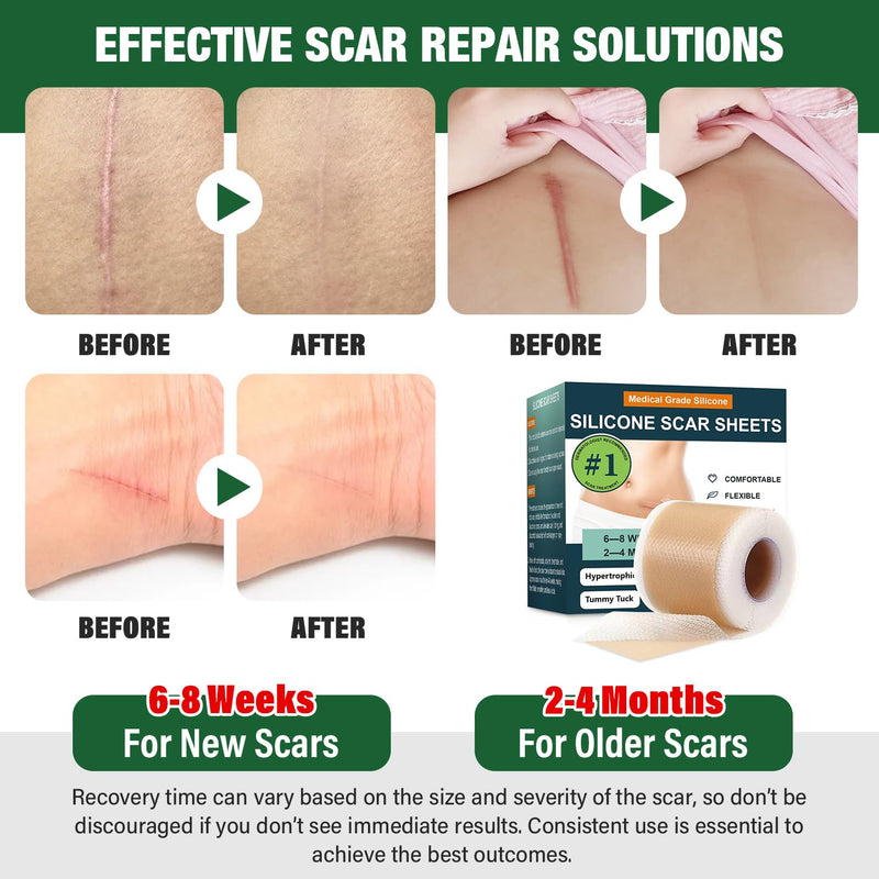 Silicone Scar Sheets,Silicone Scar Tape,Silicone Sheets For Scars,Scar Tape For Surgical Scars,Keloid Bump Removal,Scar Removal For Surgical(1.6"x 60" Roll-1.5M) - BeesActive Australia