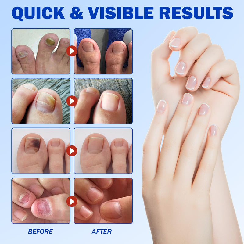Nail Patches for Toenails, 42PCS Nail Ingrown Toenail Treatment - 8-Hour Overnight Hydrogel Repair for Toenail & Fingernail, Strengthen Brittle Nails, Nail Treatment Patches for Toenail 21 Count (Pack of 2) - BeesActive Australia