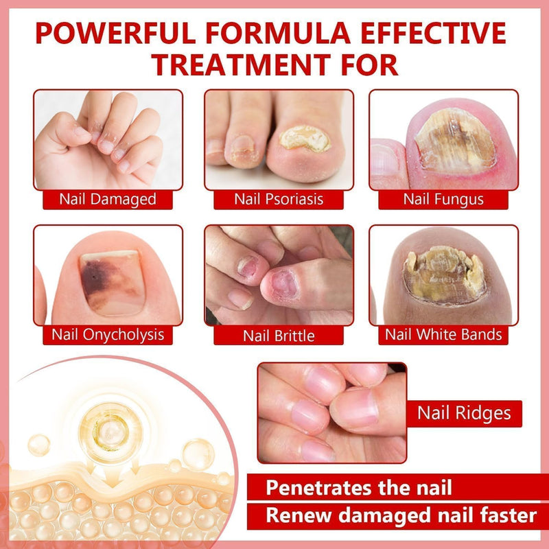 Toenail Fungus Treatment Extra Strength, Nail Fungus Treatment for Toenail, Natural Plant Extracts Toe Nail Fungus Treatments for Athletes Foot 10 Fl Oz (Pack of 1) - BeesActive Australia