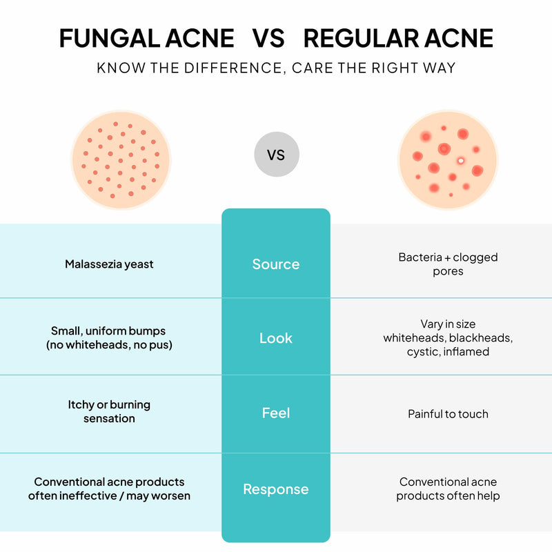 BellamiLuxx Fungal Acne Treatment Lotion: Effective Face & Body Pimple Cream for Bumps, Clusters, Itch & Redness – Fungal Prone Skin Acne Treatment Moisturizer for Teens & Adults with Natural Actives 1-Bottle - BeesActive Australia