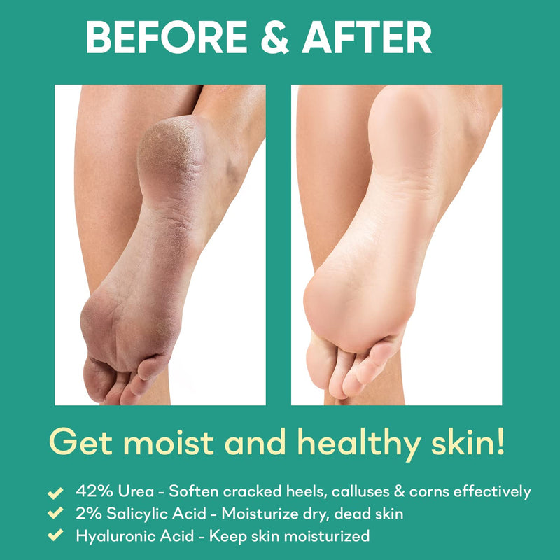 42% Urea Gel - Max Plus Salicylic & Hyaluronic Acid cracked heel repair callus remover for Elbows, Feet, and Hands, and cracked heel, calloused feet remover gel 4oz