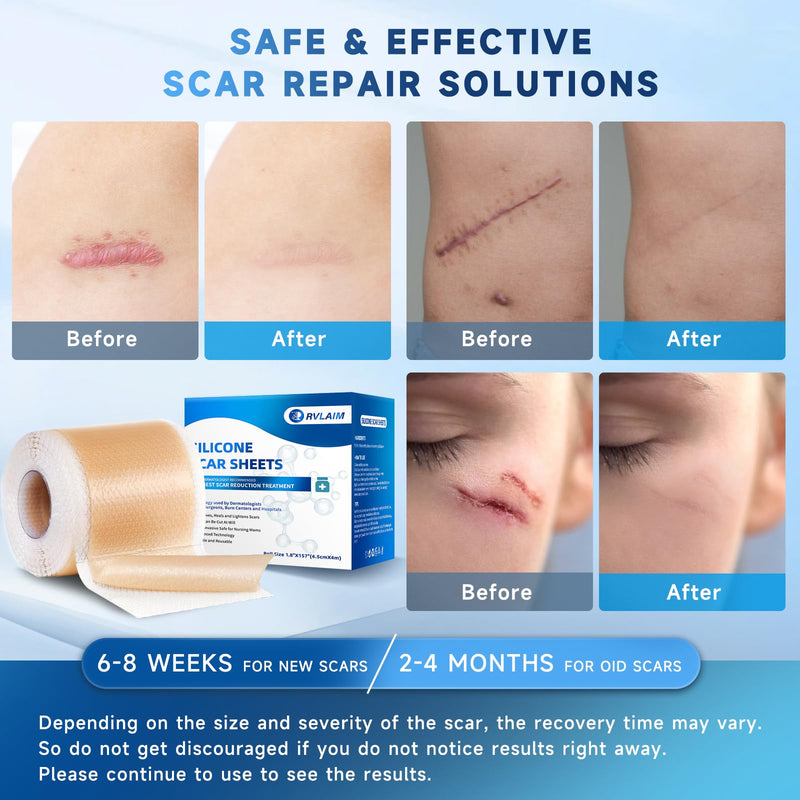 Rvlaim Silicone Scar Sheets, Silicone Scar Tape(1.8” x 157” Roll 4M), Silicone Scar Sheets for Surgical Scars, Keloid Bump Removal, Stretch Marks Removal, C-Section, Burn et - BeesActive Australia