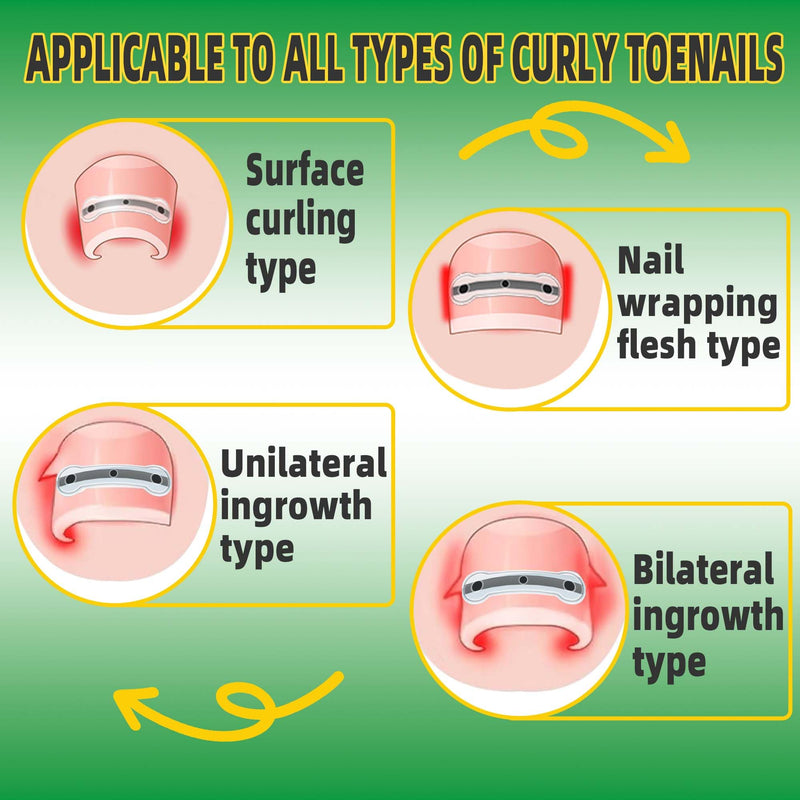 Ingrown Toenail Treatment Kit, Titanium Alloy Ingrown Toenail Removal Kit, Nails Corrector Tool & Remover Strips - Ingrown Toe Nail Quick Relief 10 Count (Pack of 1)