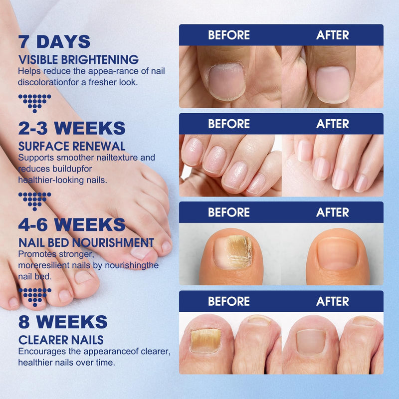 Toenail Fungus Treatment Extra Strength - 42 Pcs Fungal Nail Patches, nail repair patches-8-Hour Firm Adhesion, Nail Repair patches for Damaged Nails, Overnight Renewal for Men and Women 1.82 Ounce (Pack of 2) - BeesActive Australia