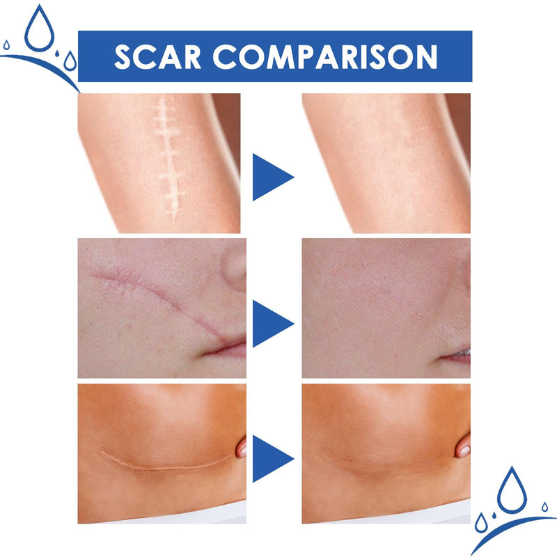 （2 pcs）Scar Removal Cream: Smooth and Tighten Skin, Repair Scars 抚痕祛疤！平滑紧致肌肤 疤痕修护霜