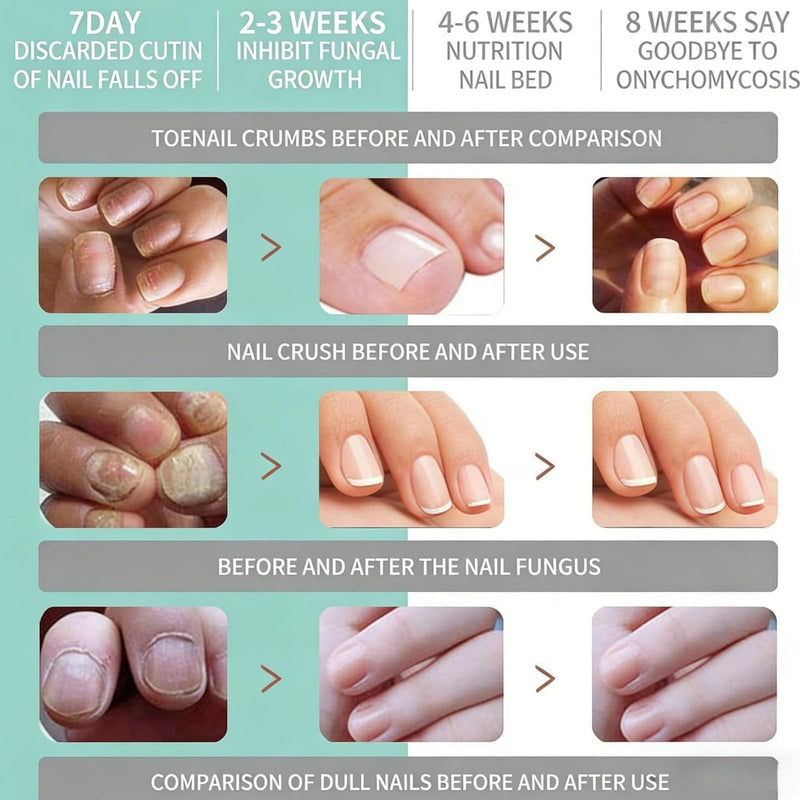 Toenail Fungus Treatment Extra Strength, Nail Repair for Damaged Nails with 25% Undecylenic Acid & Tolnaftate, Fungal Treatment for Toenails & Fingernails