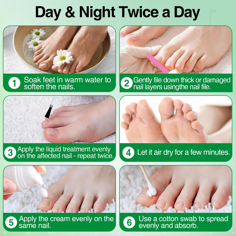 Toenail Fungus Treatment, 25% Undecylenic Acid Nail Repair Liquid 30ML & Clarus Tolnaftate 1% Toenail Fungus Cream 30g Set for Yellow toenails, Damaged Nail treatment extra strength with Tea Tree Oil 1 Fl Oz (Pack of 1)