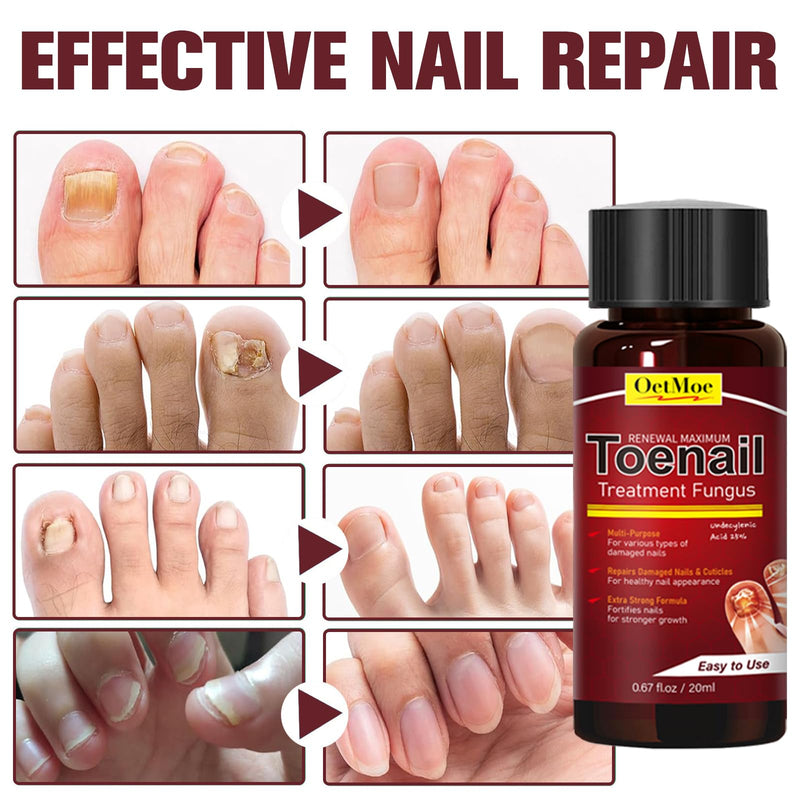 Toenail Fungus Treatment Extra Strength, Nail Fungus Treatment for Yellow, Thick, Discolored, Broken Nails, Ultimate Fungal Nail Repair, Make Nails Look Healthier Stronger, 2 Bottles - BeesActive Australia