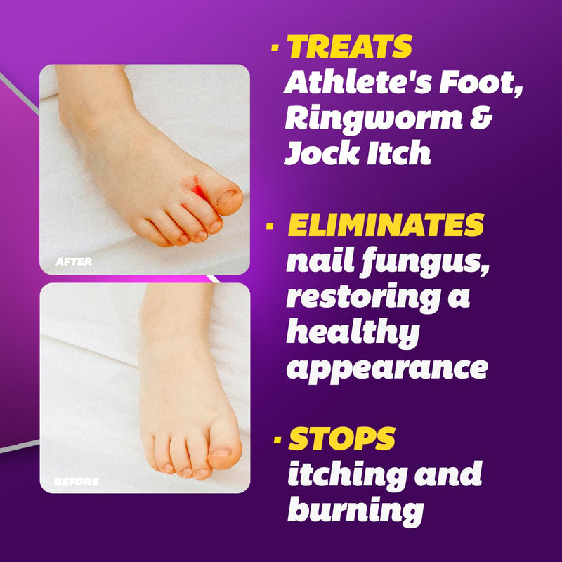 Silka Max Strength Antifungal Liquid & Cream Set - Powerful Relief for Toenail Fungus, Athlete's Foot, and Ringworm, Itch and Burn Relief - BeesActive Australia