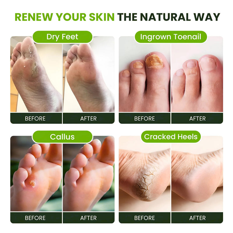 FOOT CURE Tea Tree Oil Foot Soak with Epsom Salt - Best Toenail Fungus Treatment, Athletes Foot & Softens Calluses - Soothes Sore & Tired Feet, Fungal Toe, Foot Odor Scent, Spa Pedicure (Pack of 2) | Tea Tree Oil, with Epsom Salt, Fungal Toe, Foot Odor... - BeesActive Australia