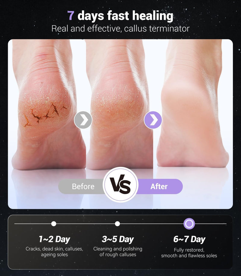 5-in-1 Professional Electric Callus Remover(Portable & Foldable), Removes 99.92% of Calluses in 3 Mins, Rechargeable Foot File Pedicure Kits with 10 & 40 Grit Pads for Soft Smooth Feet, Purple 03-purple - BeesActive Australia