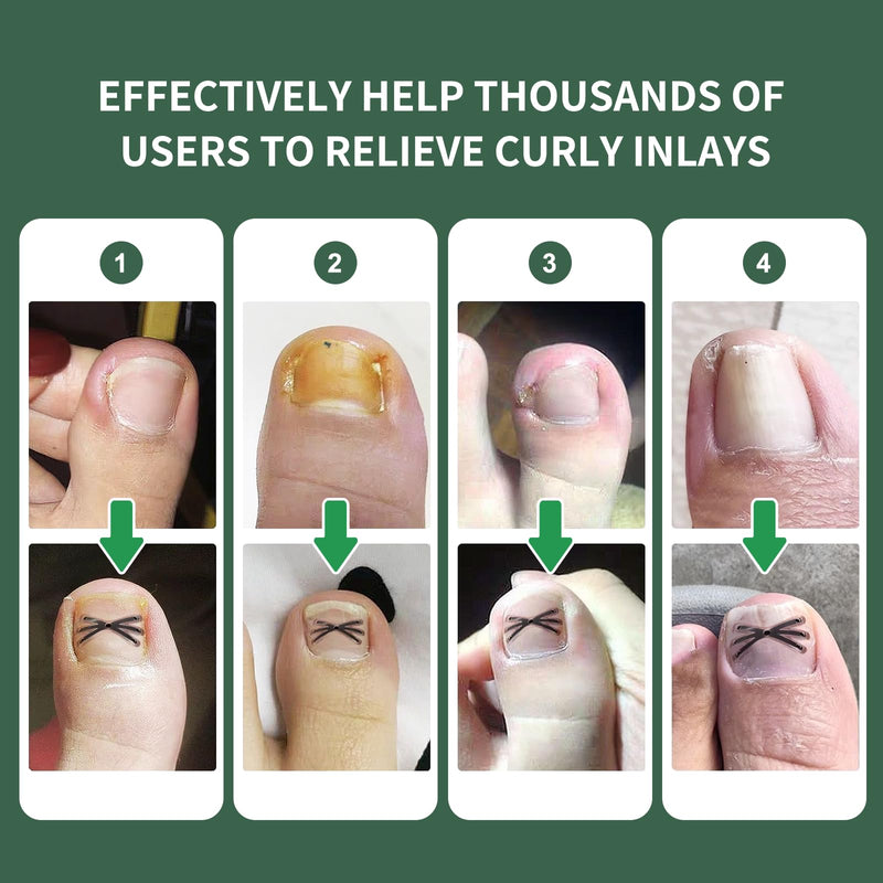 Titanium Alloy Ingrown Toenail Treatment 3X Stronger Pulling Force, Nail Tools and Ingrown Toenail Repair Kit for Curved & Thick Nails, Professional Foot Care Solution for Men & Women (0.63/0.67 in) 0.63-0.67in