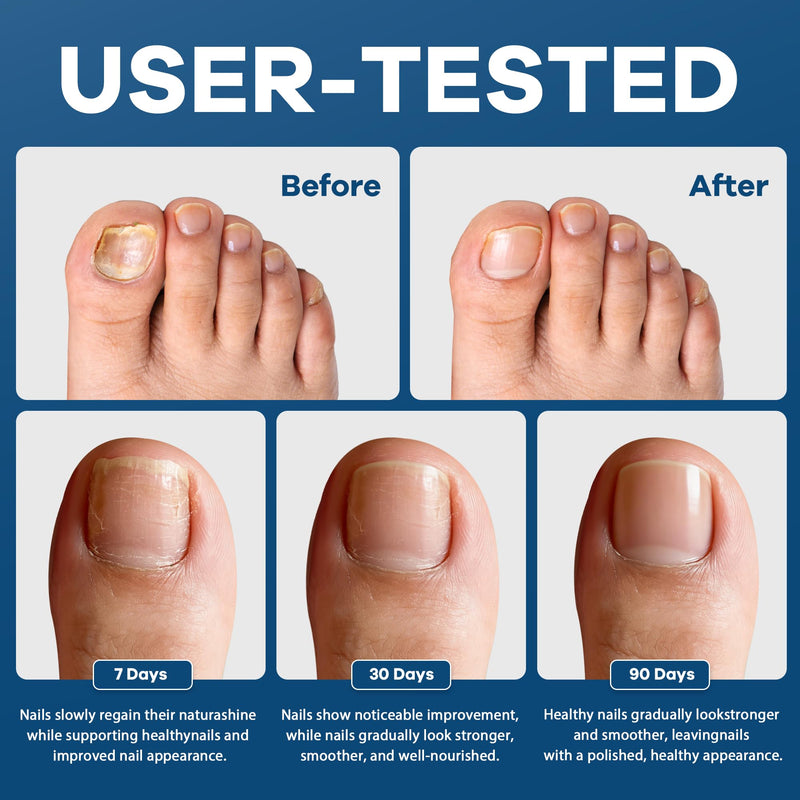 FSA Eligible HSA Extra Strength Athlete‘s Foot & Toenail Fungus Treatment Pen, Toenail Treatment Pen with 25% Undecylenic Acid, Precision Applicator for Itch Relief & Nail Car - 3 Pack/6 Pack (3 Pack) - BeesActive Australia