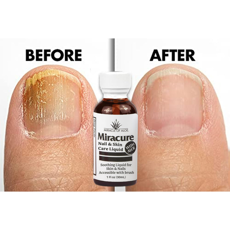 Miracle of Aloe’s Nail & Foot Care Liquid with UltraAloe, Brush & Toe Separators (1 oz)