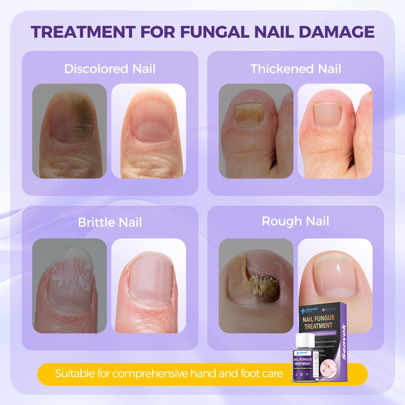 Toenail Treatment Extra Strength, Fast-Acting Toe Nail Treatments, Safety Restore and Renew Discolored & Damaged Nails, Improve Nail Health and Appearance 2.5 ML