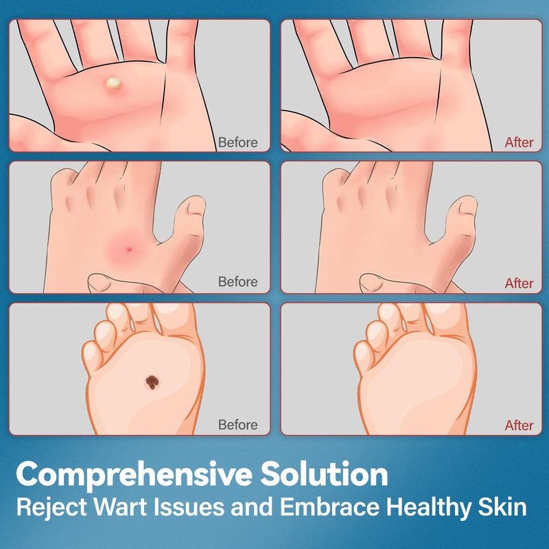 Goodnites Fast-Acting Wart Remover with Maximum Strength Salicylic Acid, Effectively Removes Common & Plantar Warts, Safe for Family Use, 1 fl oz, 1 PCS - BeesActive Australia
