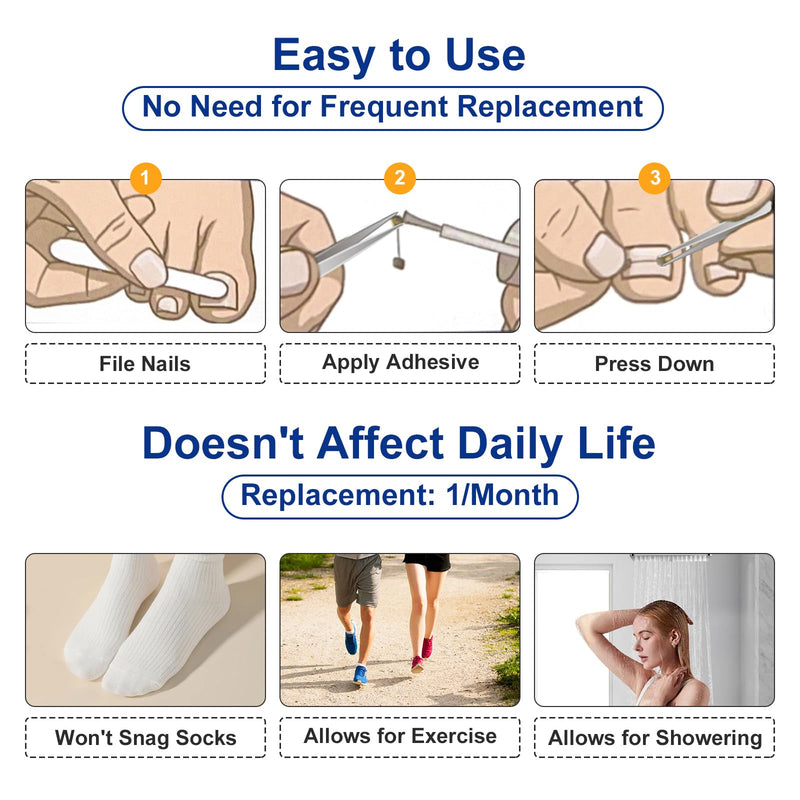 Nitinol Ingrown Toenail Corrector,at Home Ingrown Toenail Treatment,Curved Toenail Straightener,Ingrown Toe Nail Relief，Ingrown Toenail Removal Kit (11/16 In,13/16 In) 11/16 In,13/16 In