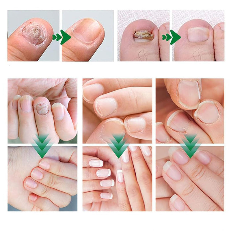 Nail Fungus Treatment Gel, Natural Nail Repair Care Gel, Nail Oil for Growth & Strength, Nail Growth Serum, Strengthening Cuticle Serum - 2pcs 0.1 Fl Oz (Pack of 2)