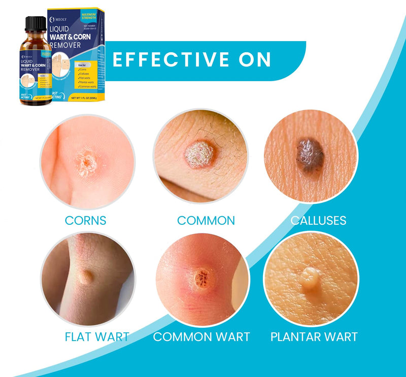 Salicylic Wart Removal Freeze Away: Fast-Acting Wart Removal Maximum Strength for Men and Women - Plantar Wart Genital Wart Corns Calluses 30 ML 1 Ounce - BeesActive Australia