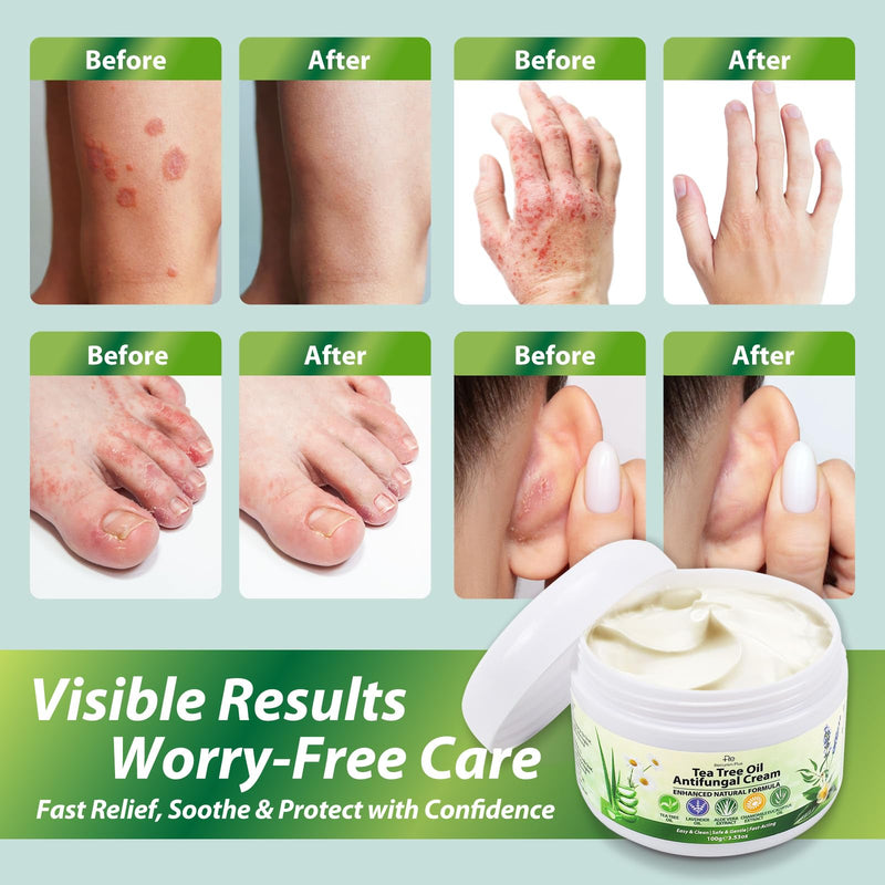 Antifungal Cream with Tea Tree Oil ‚Äì Advanced Herbal Relief for Skin Fungus, Jock Itch, Eczema, Athlete's Foot, Tinea Versicolor, Natural Treatment ‚Äì 100g 3.5 Ounce (Pack of 1)