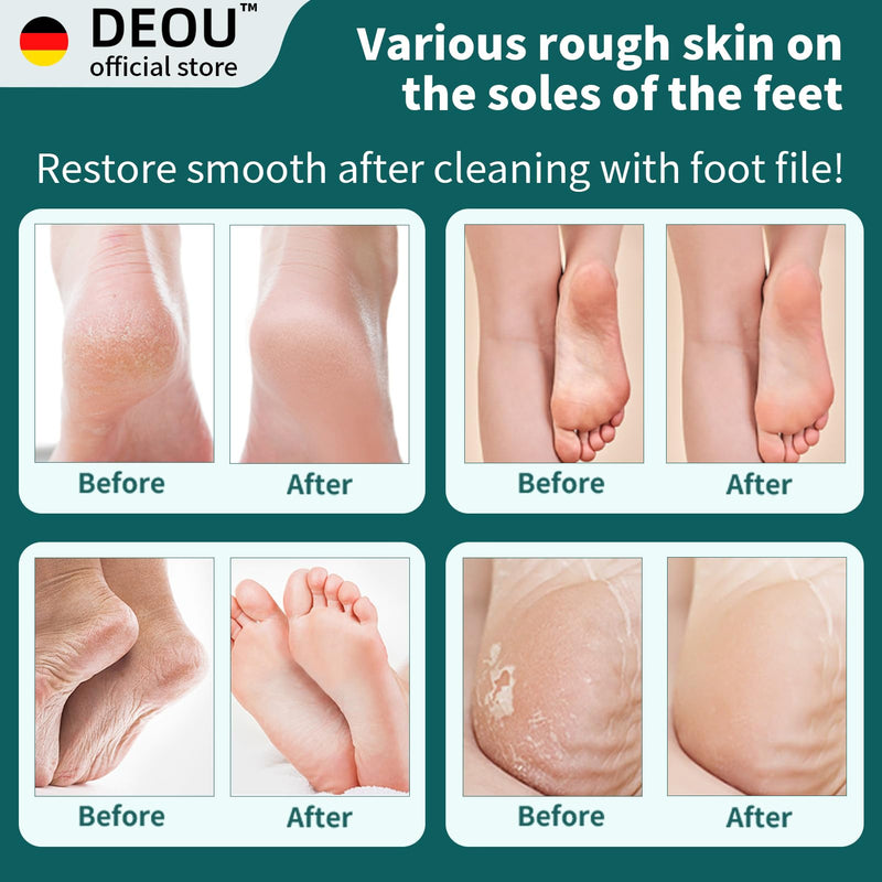 DEOU Metal Foot File SStainless Dead Skin Callus Remover for Dead Skin Professional Secure Foot Scrubber Heel Scraper Cracked Heels Repair Pedicure Tools for feet Black - BeesActive Australia