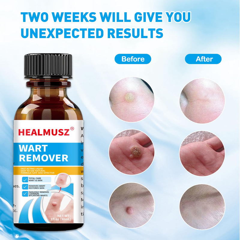 Fast Action Liquid Wart Remover Natural Formula Wart Liquid Designed for Warts, Plantar Wart, Common Wart, Flat Wart, Corn(NDC Code：84010-004-01) - BeesActive Australia