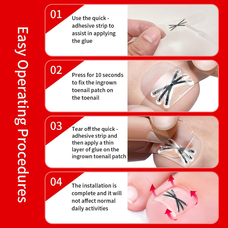 Upgraded Titanium Alloy Ingrown Toenail Corrector with Upgraded 6-Angle Shape,3x Stronger Pull Force,Ingrown Toenail Removal Kit, Ingrown Toenail Treatment for Women and Man (Small size) 1 Count (Pack of 14) - BeesActive Australia