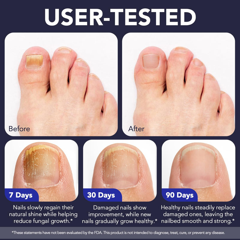 Toenail Fungus Treatment Extra Strength, Nail Fungus Pen, 25% Undecylenic Acid with added Tea Tree Oil, Jojoba, Clove Bud Oils & Aloe, Fast-Acting Solution for Toe & Fingernail Fungi, 5PCS blue