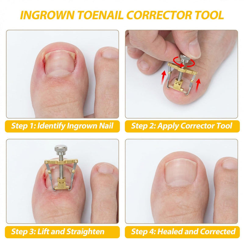 8-Piece Ingrown Toenail Removal Kit & Ingrown Toenail Corrector Tool – Ingrown Toenail Lifter, Ingrown Toenail Tool with Storage Box, in Stainless Steel Pedicure Tools for Paronychia & Dead Skin - BeesActive Australia