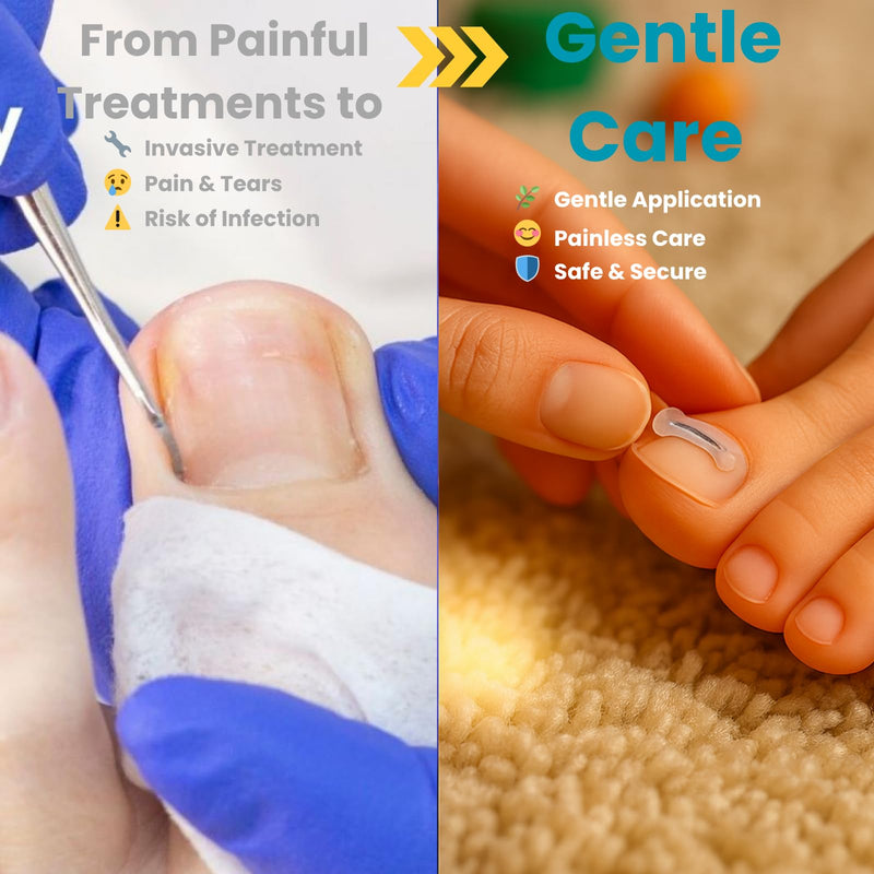 Kids Ingrown Toenail Corrector, Gentle & Safe Ingrown Toenail Treatment for Children, At-Home Solution for Kids Ingrown & Curved Nails, Comfortable Lift for Delicate Nails (0.31 Inch) 0.31 Inch