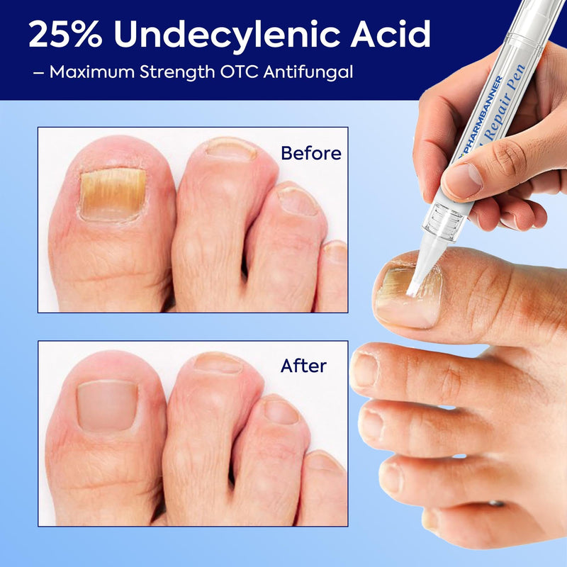 Nail Fungus Treatment Extra Strength: 25% Undecylenic Acid Formula - Toenail Fungus Treatment Kit with 5 Pens & Nail File for Ingrown Nails, Discoloration & Brittle Nails 0.1 Fl Oz (Pack of 5)