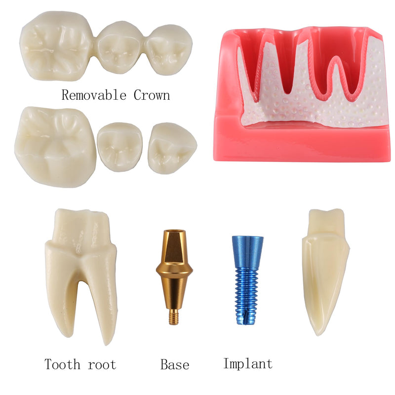 4X Dental Implant Demo Model